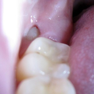 Durchbrechender Weisheitszahn