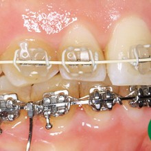 Zahnspange mit zahnfarbenen Brackets